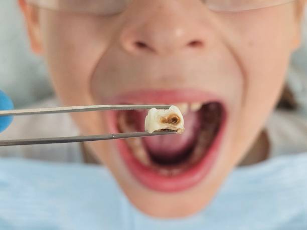 Best Emergency Dental Extractions in Strasburg, VA